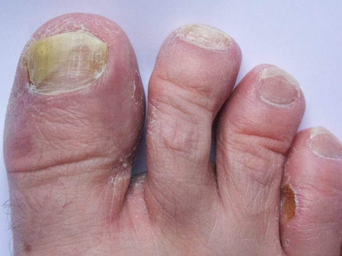 Home Remedies For Athlete s Foot Organic Facts