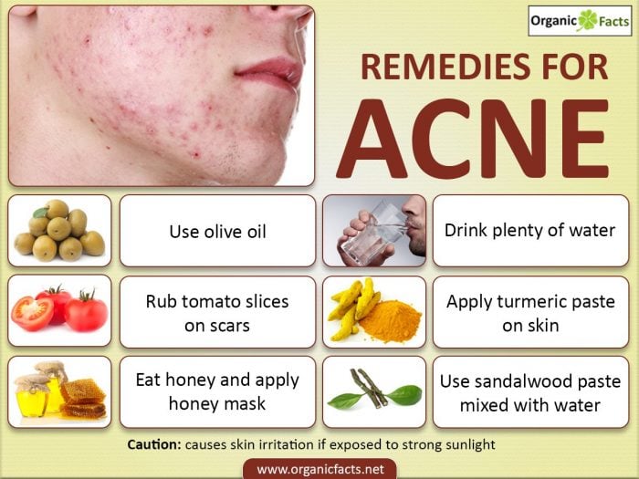 How To Clear Your Face Of Acne Scars Naturally At Lasandra Davis Blog