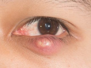 Chalazion: Causes, Symptoms, Risk factors, & Treatments