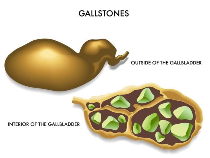 understanding-gallstone-causes-and-prevention-facty-health