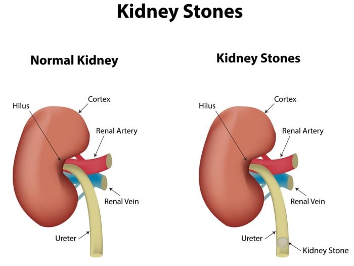 Can You Take Antibiotics For Kidney Stones