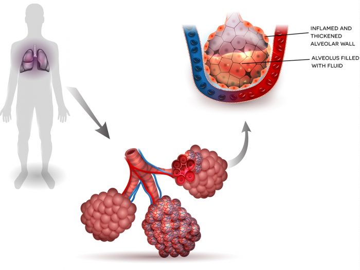 Pneumonia: Remedies & Treatments | Organic Facts