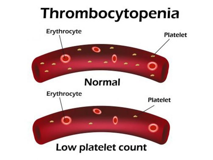 What Is Thrombocytopenia
